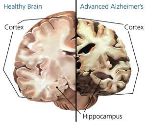 alzheimer-cerebro-imagen