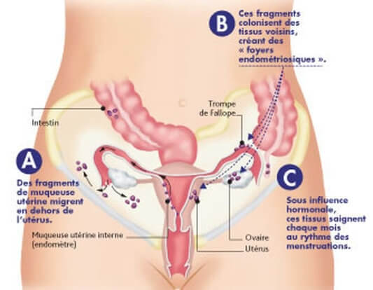 l'endométriose