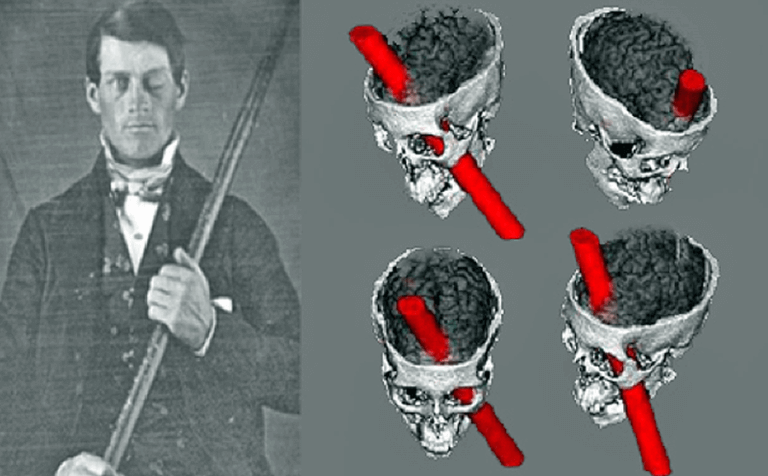 le cas clinique de Phineas Gage