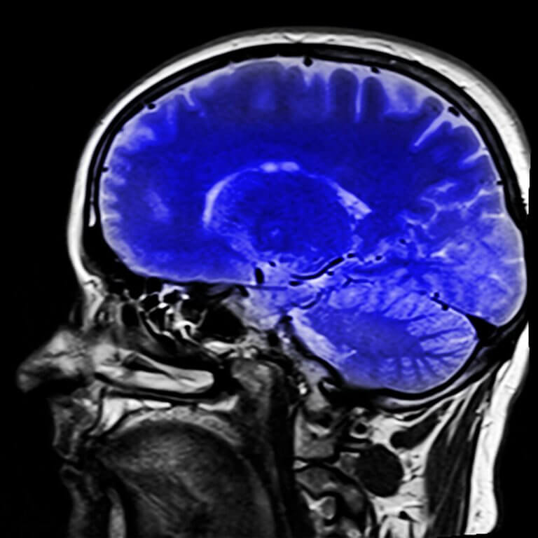 imagerie cérébrale