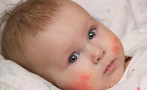 dermatite atopique sur un bébé