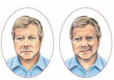 accidents vasculaires cérébraux