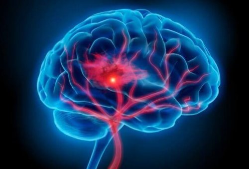 cerveau touché par la neuroinflammation
