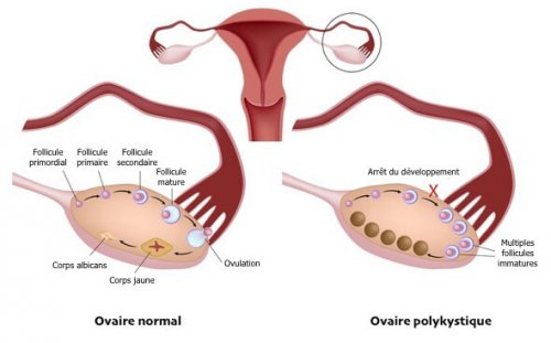 ovaires polykystiques