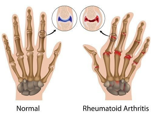 arthrite rhumatoïde