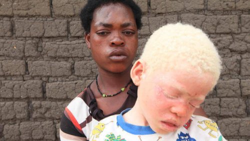 personnes albinos