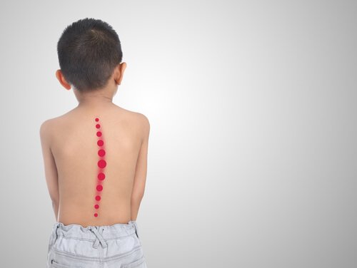 enfant avec scoliose