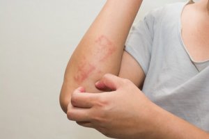 6 conseils pour prendre soin de la peau atopique