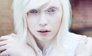 Les personnes Albinos : au-delà de l'aspect physique