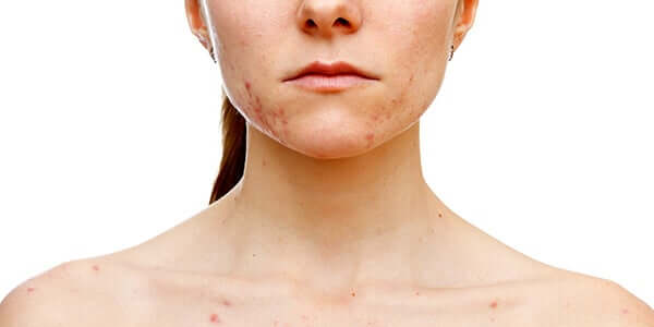 Les ovaires polykystiques provoquent de l'acné