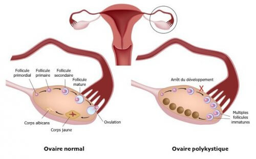 Vivre avec le syndrome des ovaires polykystiques: à quoi cela ressemble-t-il?