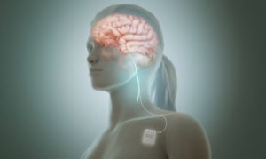La stimulation du nerf vague réduit les symptômes de la dépression
