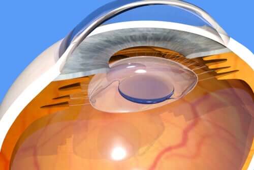 En quoi consiste l'opération de la cataracte ?