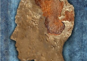 Encéphalopathie spongiforme ou maladie de la vache folle