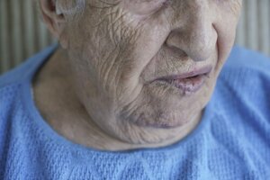 Paralysie faciale : lorsque le visage ne répond pas