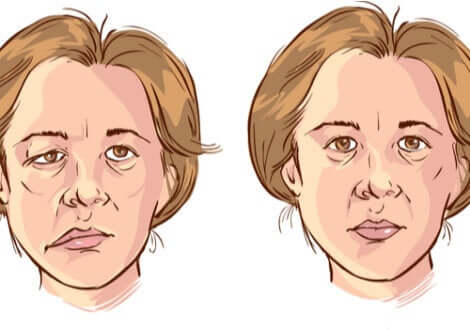La paralysie faciale d'une femme.