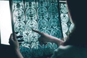 Les ondes gamma contre la maladie d'Alzheimer