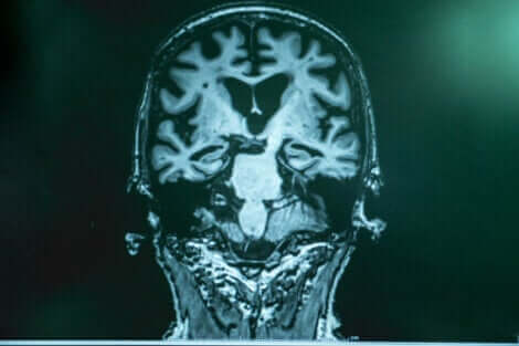 Maladie d'Alzheimer : augmenter les ondes gamma dans le cerveau. 