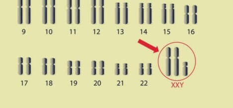 Le syndrome des chromosomes Klinefelter.