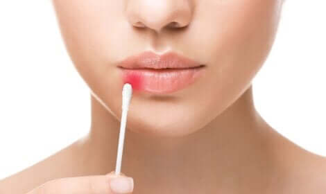 Apparition d'un herpès sur le bord de la lèvre.