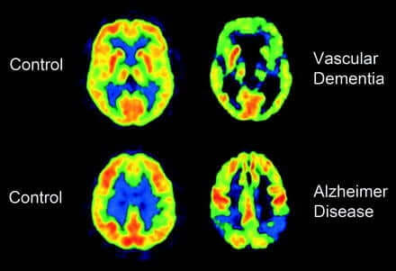Scanner du cerveau.