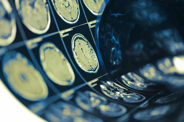 Scans du cerveau. 
