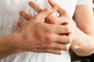 Qu'est-ce que la neurodermatite ?