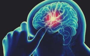 Carence en vitamine B12 et détérioration cognitive : quel est le lien ?